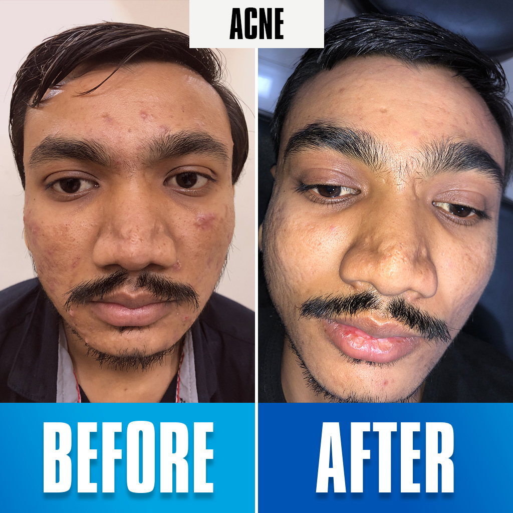 Acna treatment