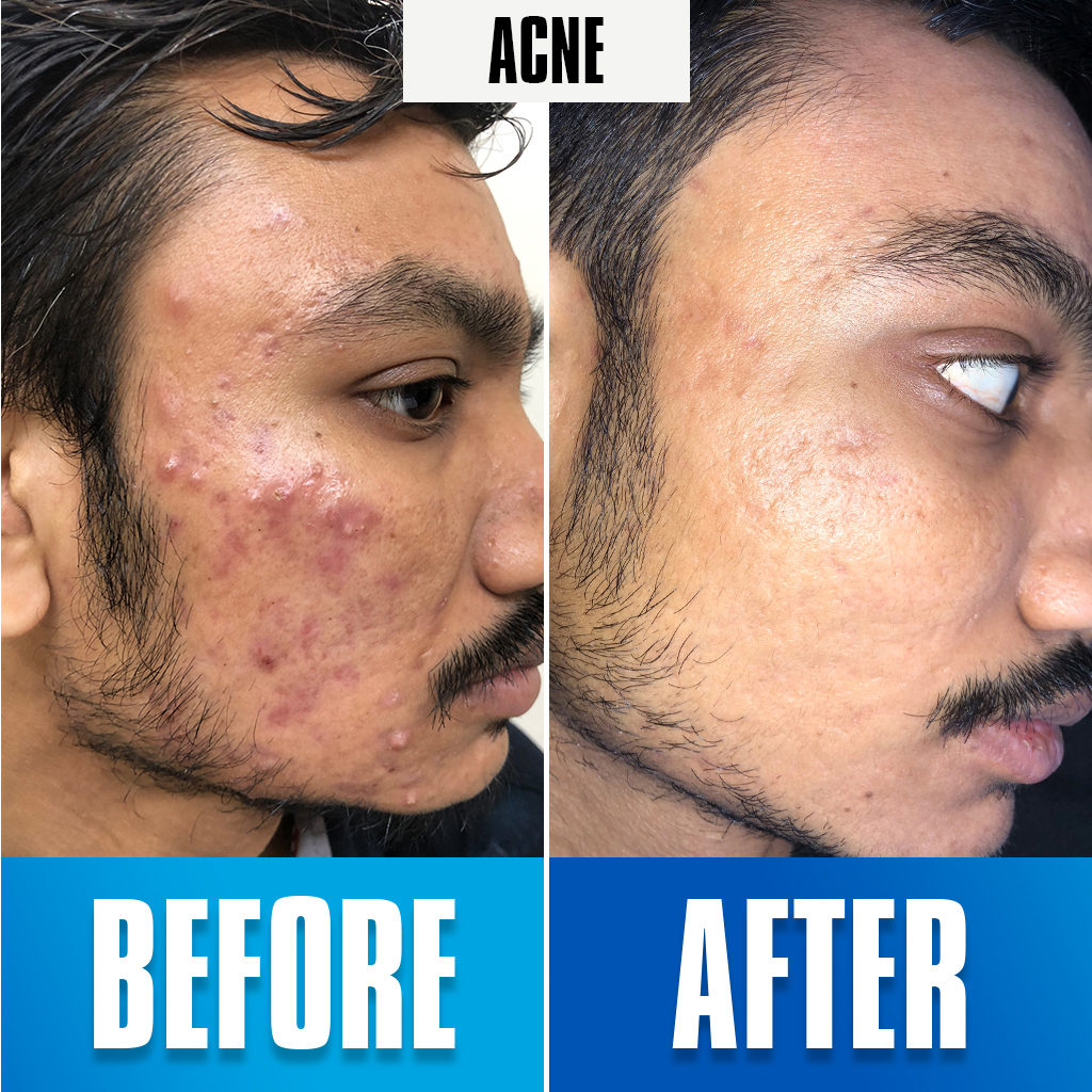 Acna treatment