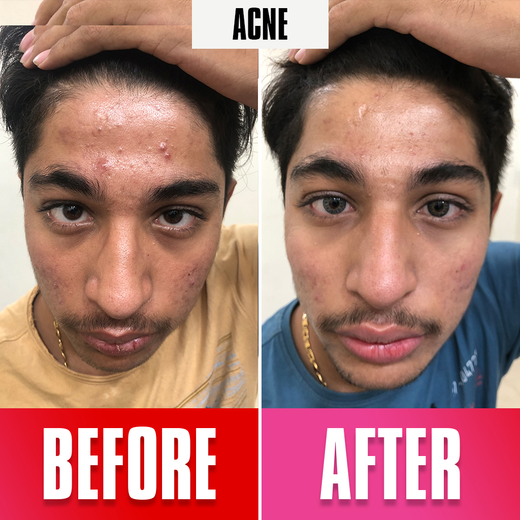 Acna treatment
