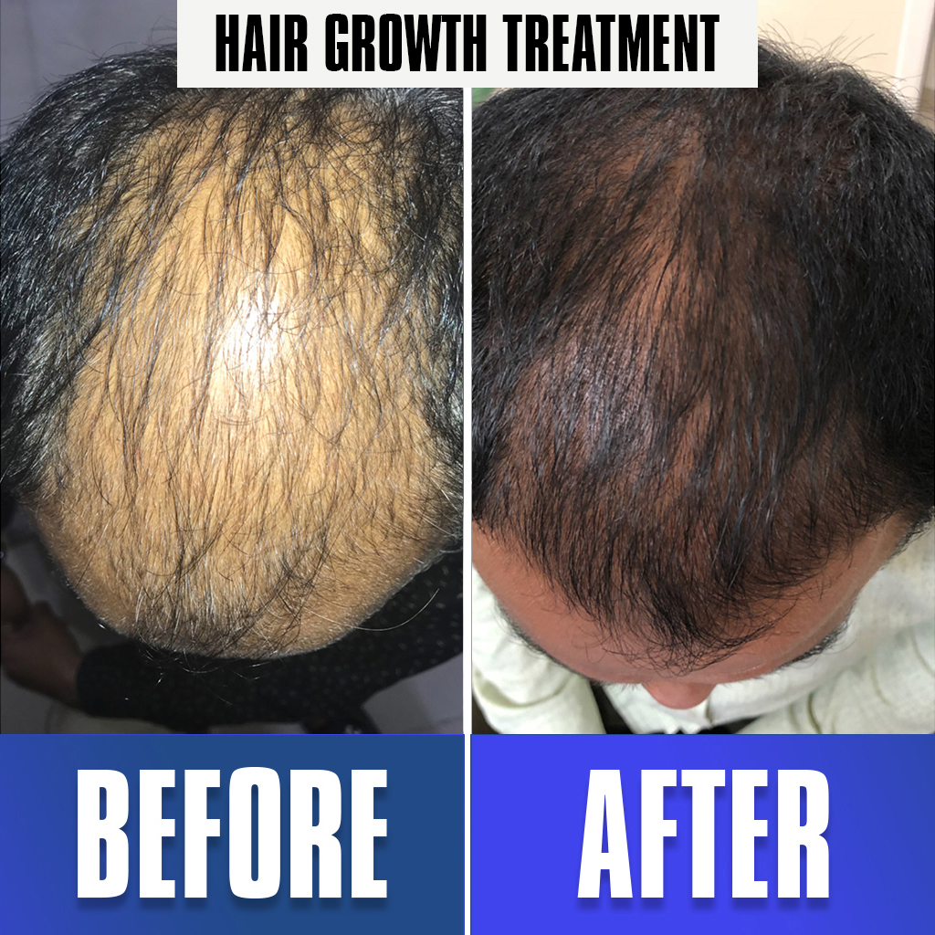Hair-Growth-Treatment