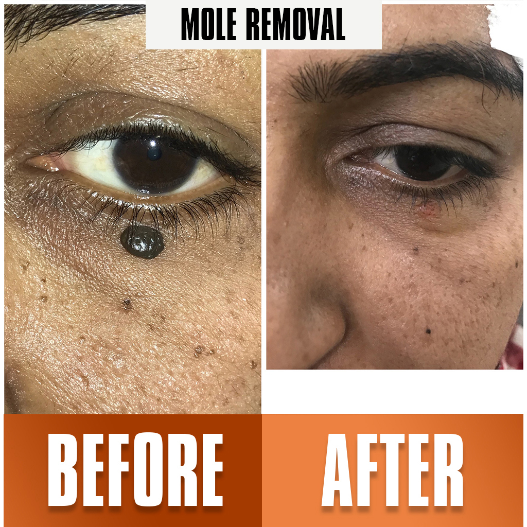 Mole-Removal