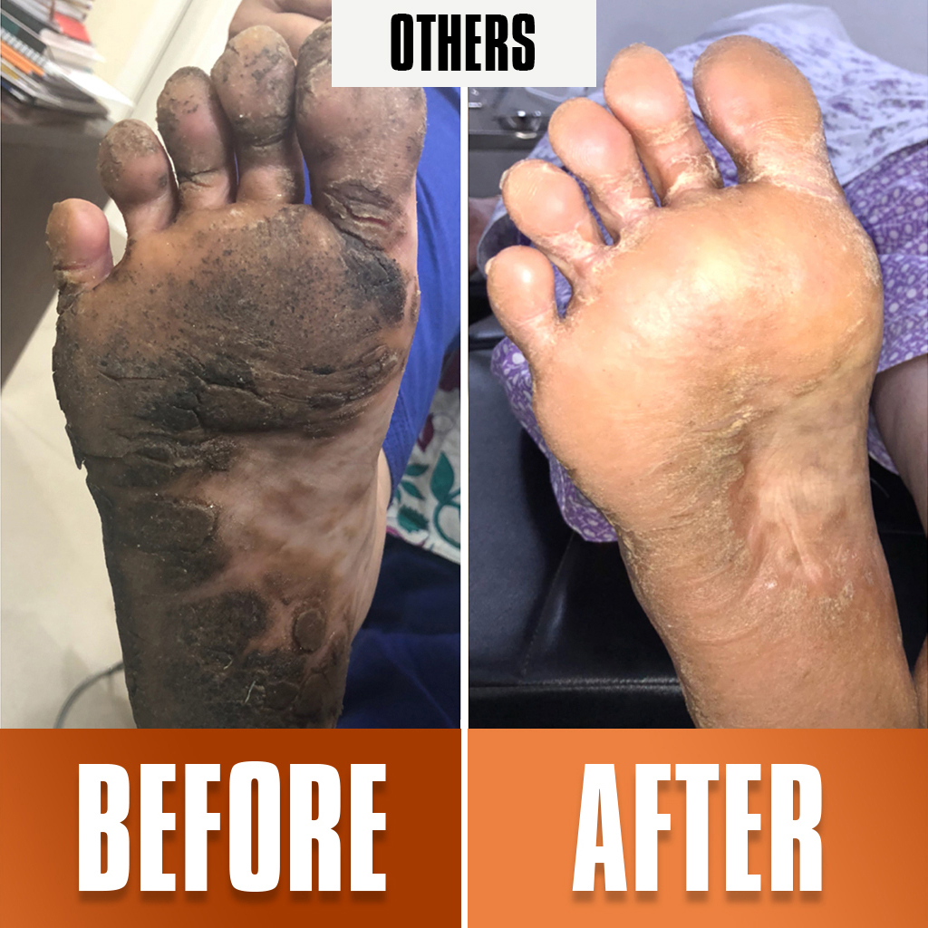 other treatment