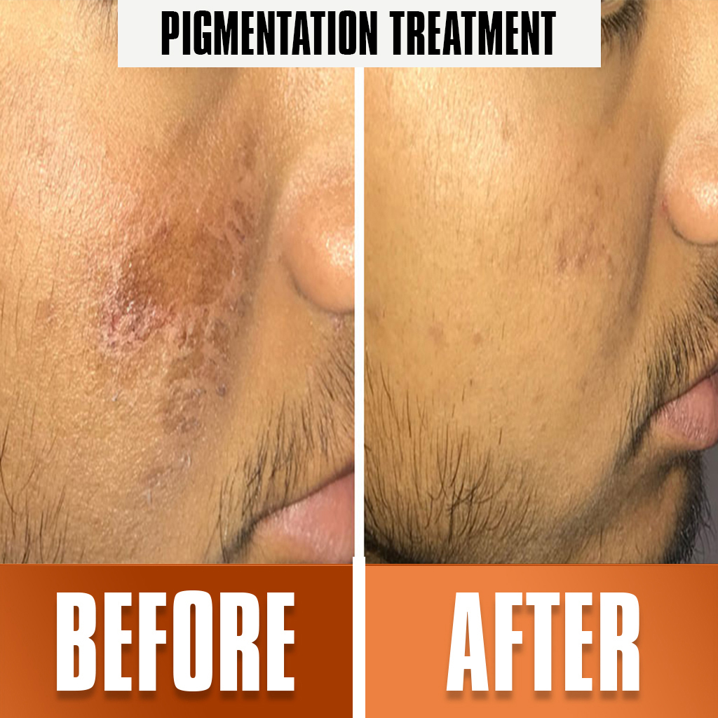 wart_removal treatment 