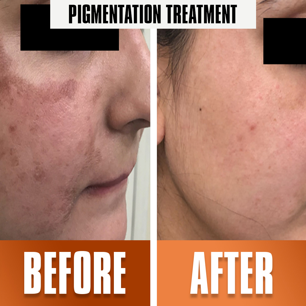 wart_removal treatment 