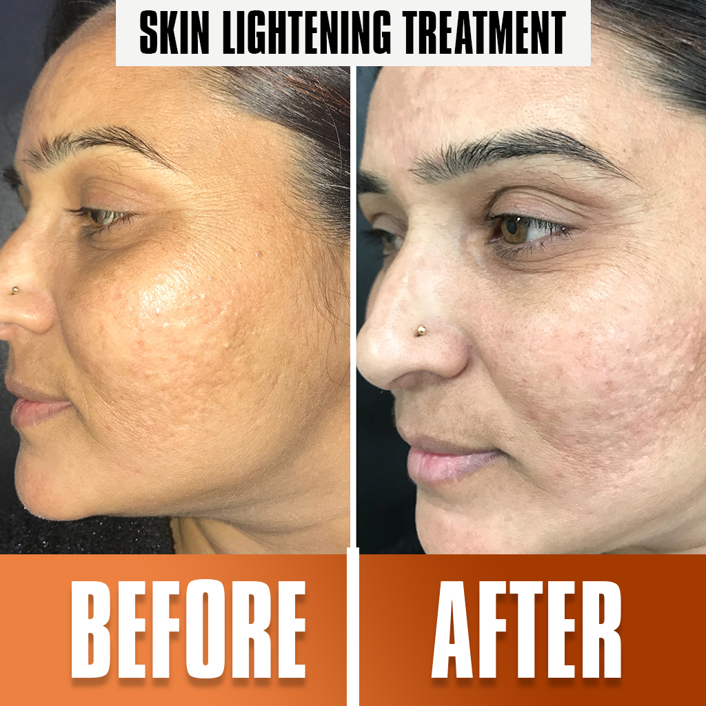 skin_lightening_treatment1