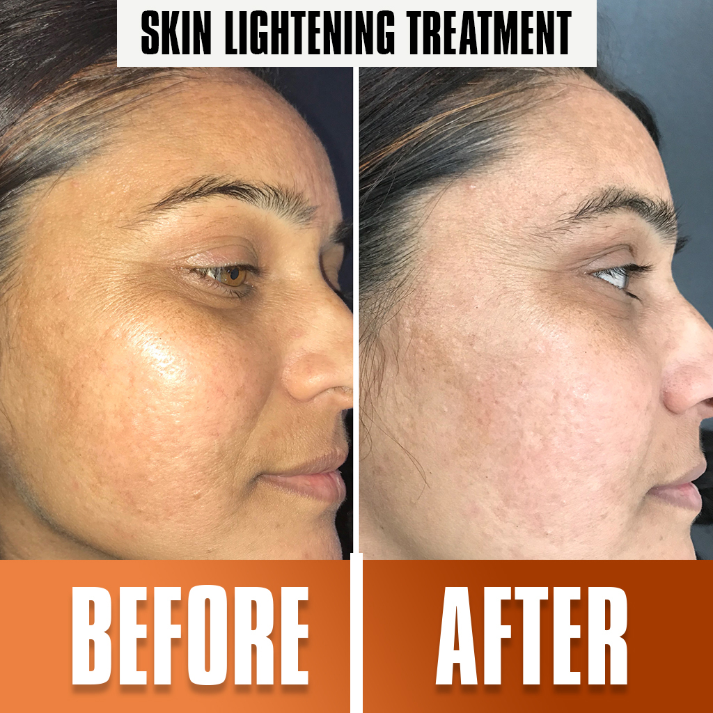 skin_lightening_treatment1