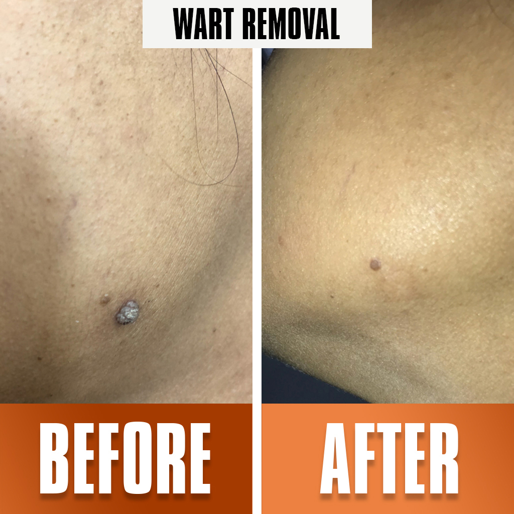 wart_removal treatment 