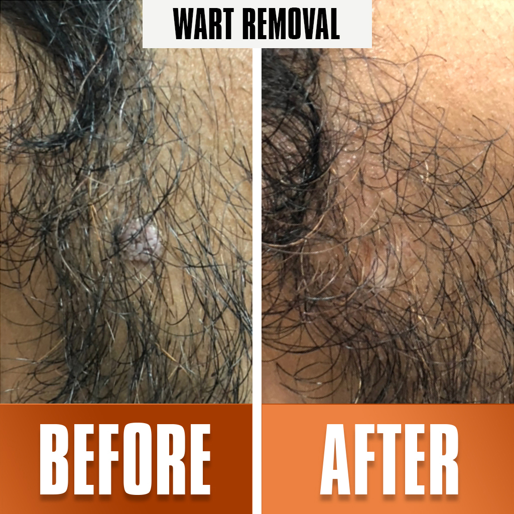 wart_removal treatment 