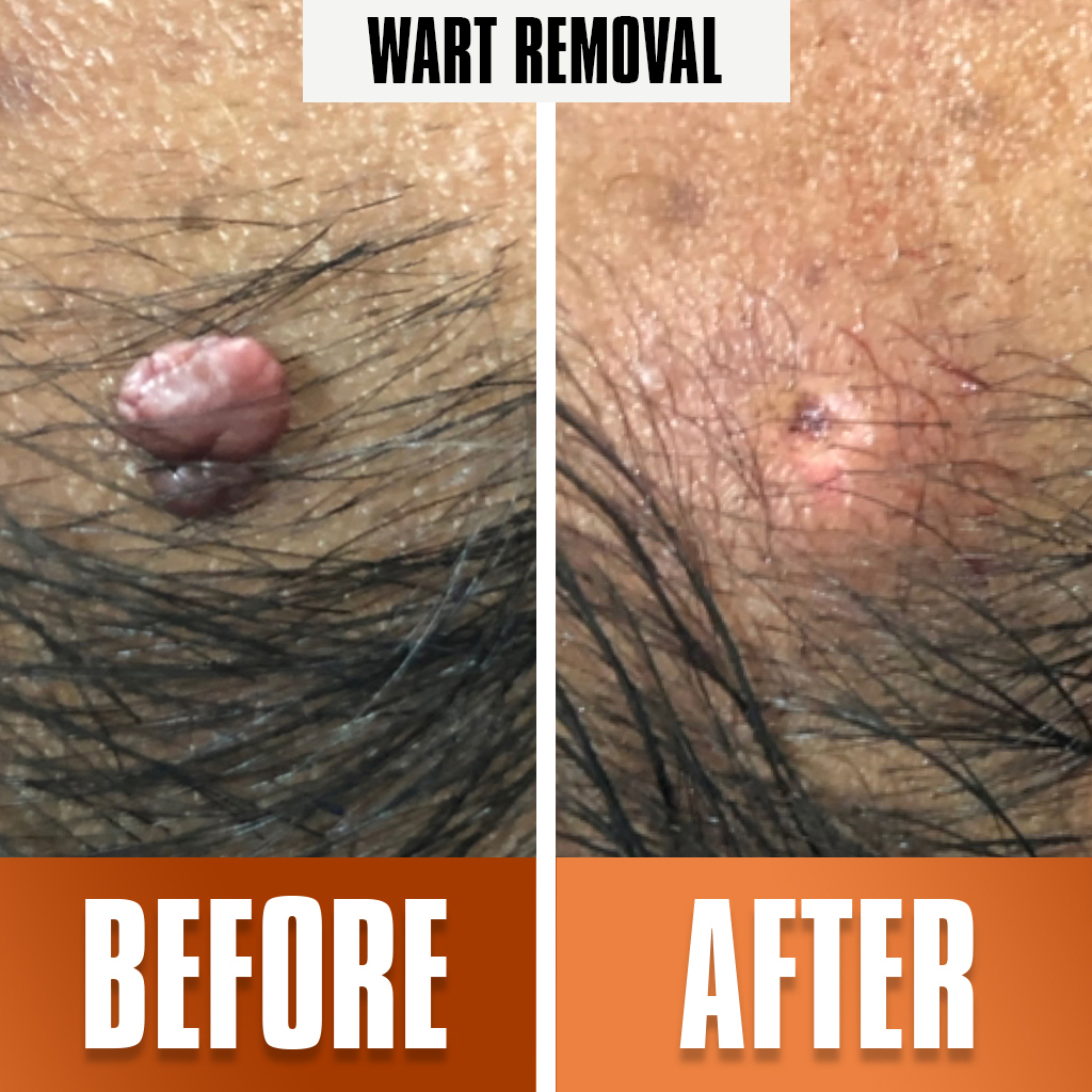 wart_removal treatment 
