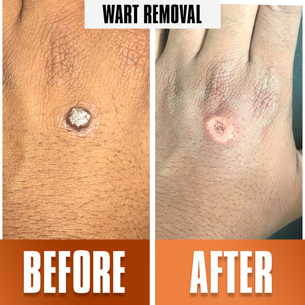 wart_removal treatment 