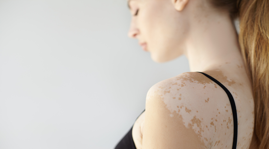 Woman with vitiligo showing confident, healthy skin