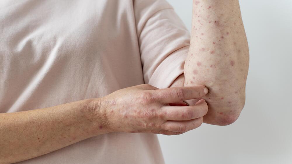Eczema skin allergy on arm